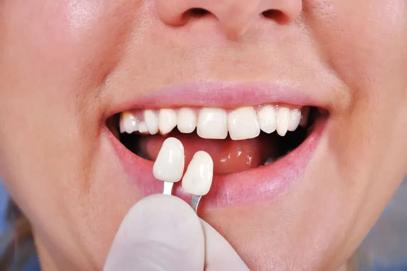 Selección del color de una carilla dental junto a una sonrisa en la Clínica Dentalbeth