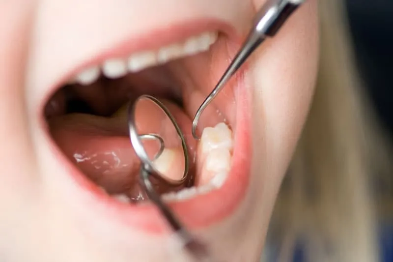 Revisión odontopediátrica de la boca de un niño con un espejo dental en la Clínica Dentalbeth
